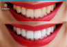 Профессиональное отбеливание зубов - 1390 грн