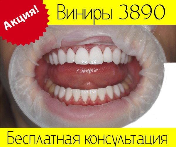 Виниры Киев 3890 грн. по Акции - изображение 1